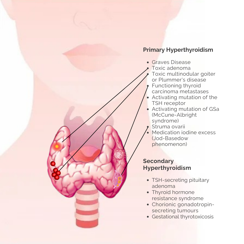 Cause of hyperthyroidism